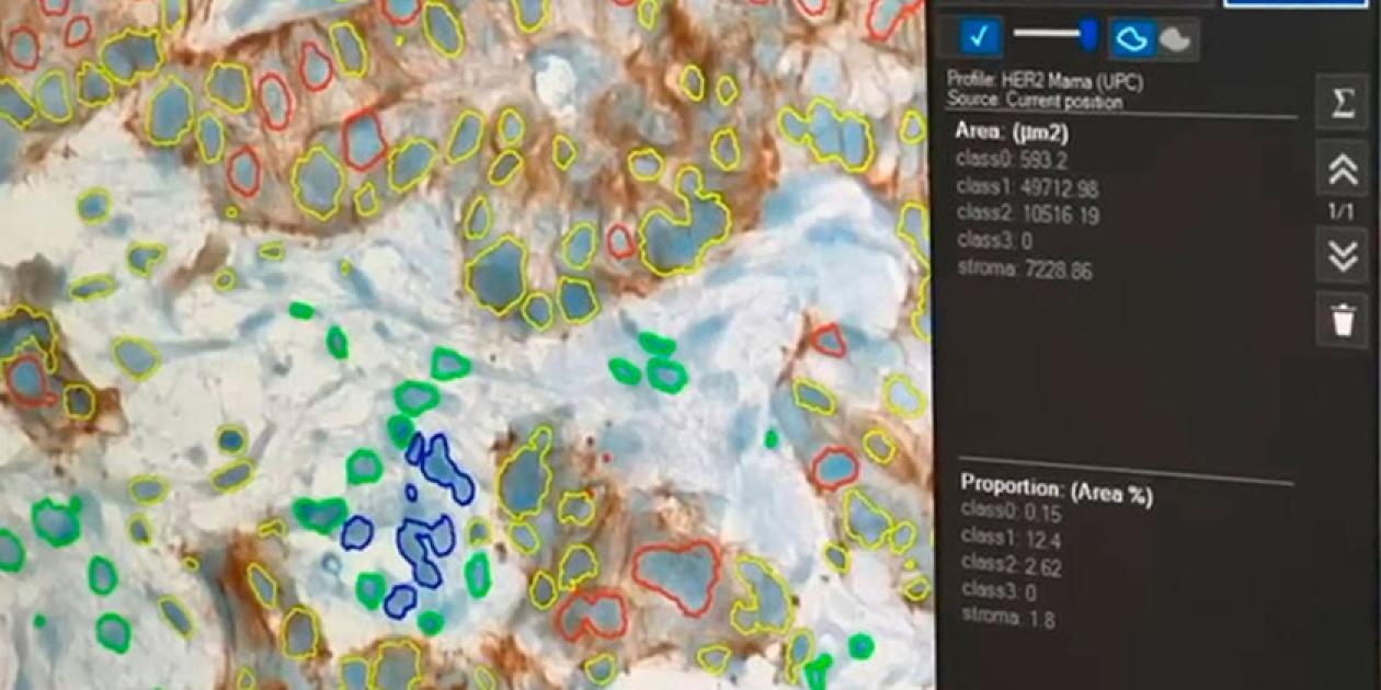 El proyecto DigiPatICS impulsa el uso de IA para acelerar y mejorar el diagnóstico del cáncer en Cataluña